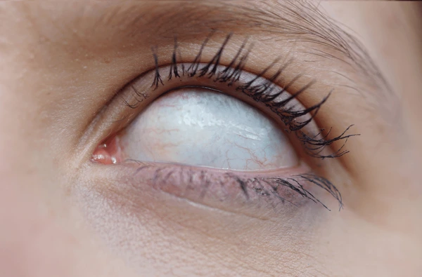 Understanding Deceased Eyes: What Really Happens After Death
